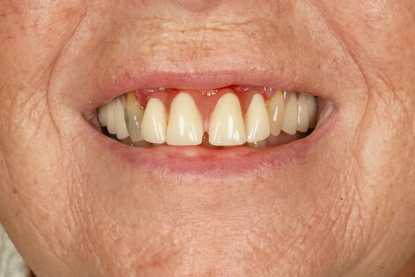 Before patient-designed replacement denture — Forest Dental Blackwood