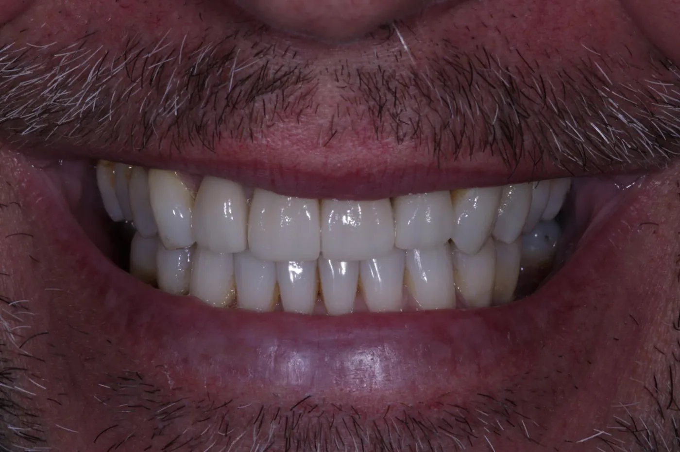 After straightened, brightened & refined — invisalign with 4 emax veneers — Forest Dental Blackwood