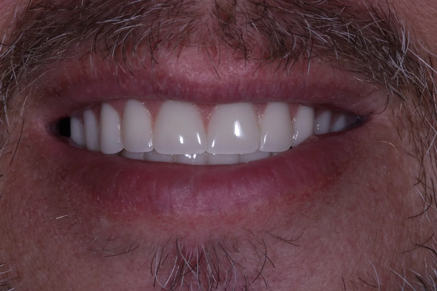 After a full reset — clearance with immediate & final upper denture — Forest Dental Blackwood