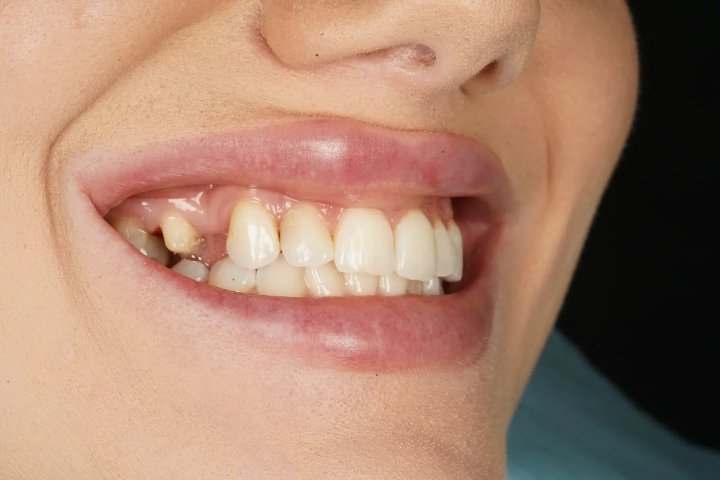 Before closing a long-standing gap with a two-unit bridge — Forest Dental Blackwood