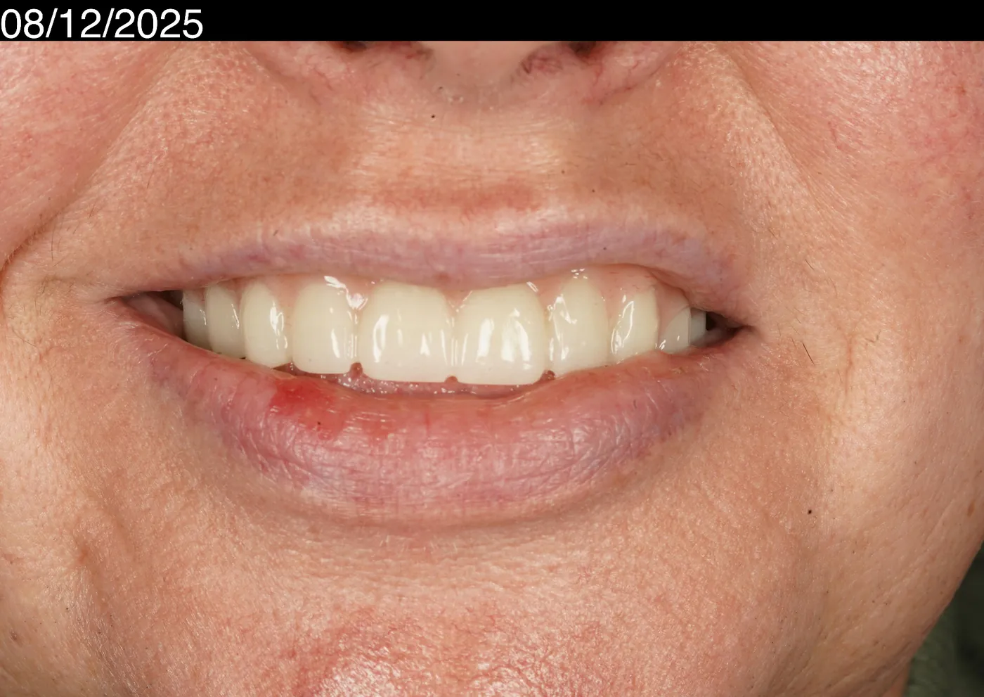 After a first smile in years — upper acrylic denture — Forest Dental Blackwood