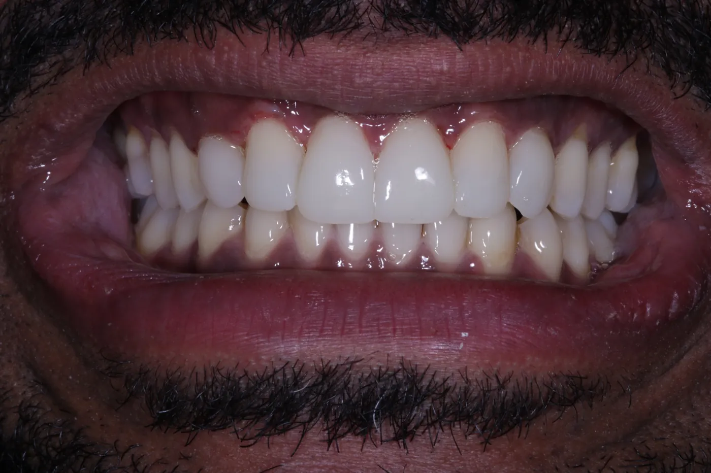 After invisalign, whitening & bonding — reshaped retained baby teeth — Forest Dental Blackwood