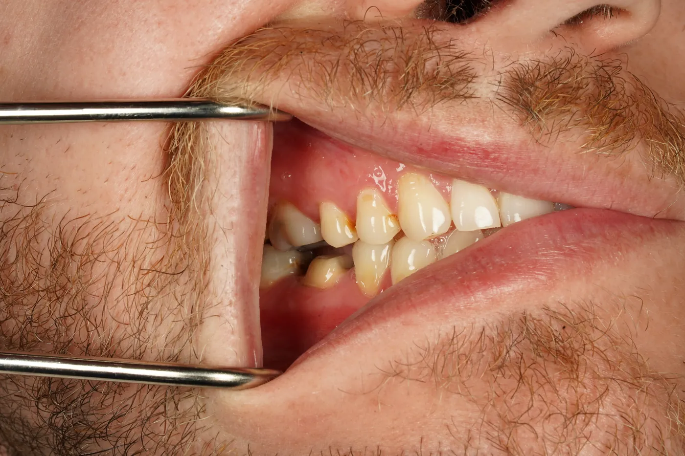 Before saved & protected — molar root canal with zirconia crown — Forest Dental Blackwood
