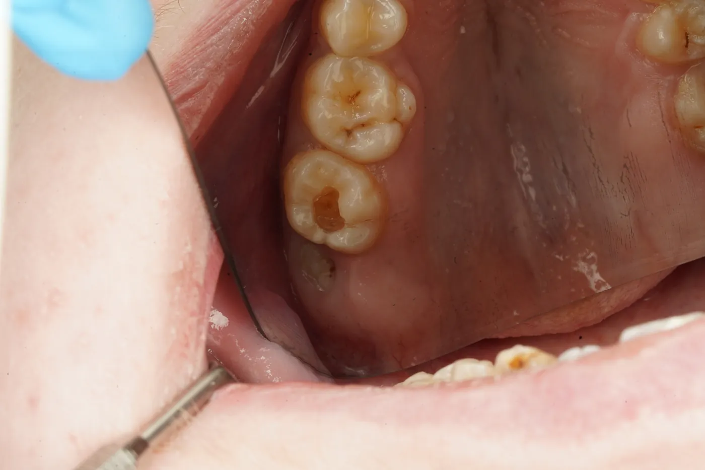 Before sensitive to bite — small cavity, composite restoration — Forest Dental Blackwood