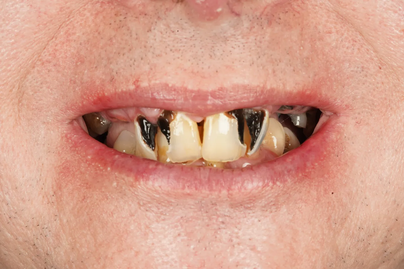 Before full mouth clearance & immediate dentures — Forest Dental Blackwood