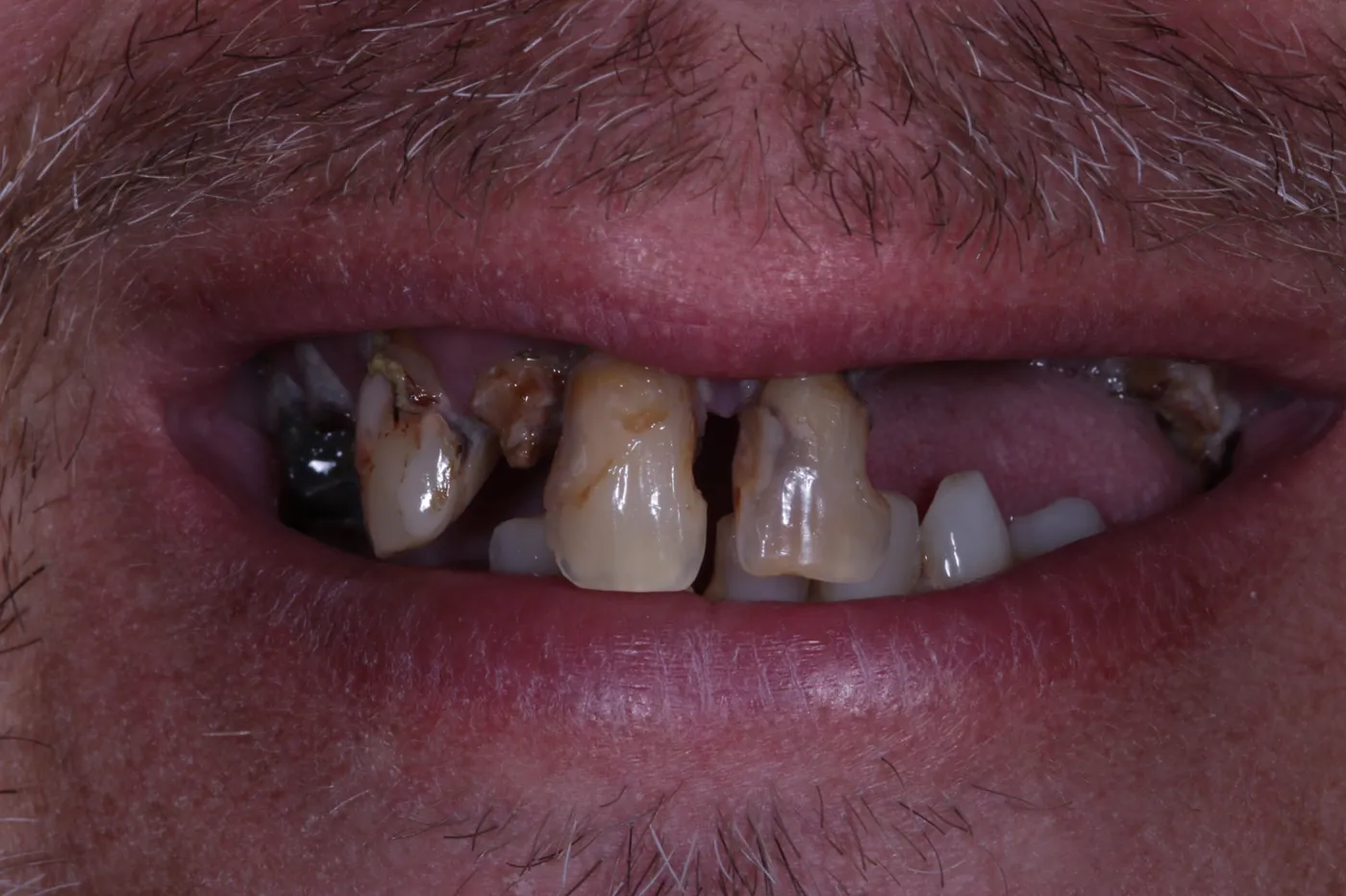 Before a full reset — clearance with immediate & final upper denture — Forest Dental Blackwood