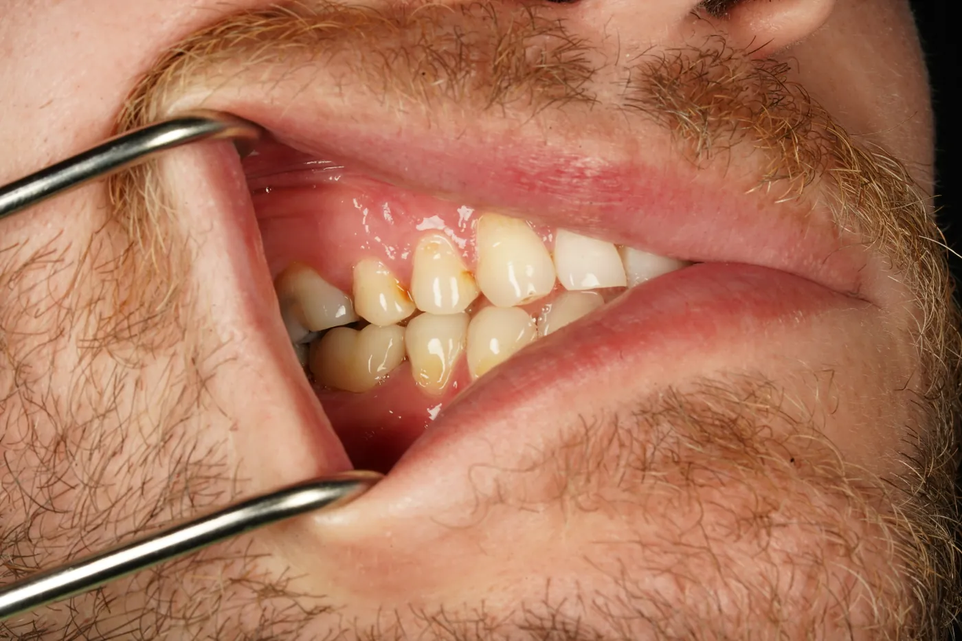 After saved & protected — molar root canal with zirconia crown — Forest Dental Blackwood