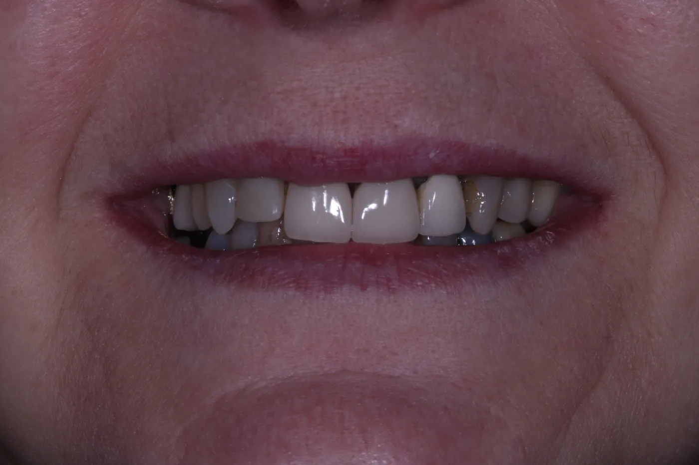 Before digital smile design — 6 layered zirconia crowns — Forest Dental Blackwood