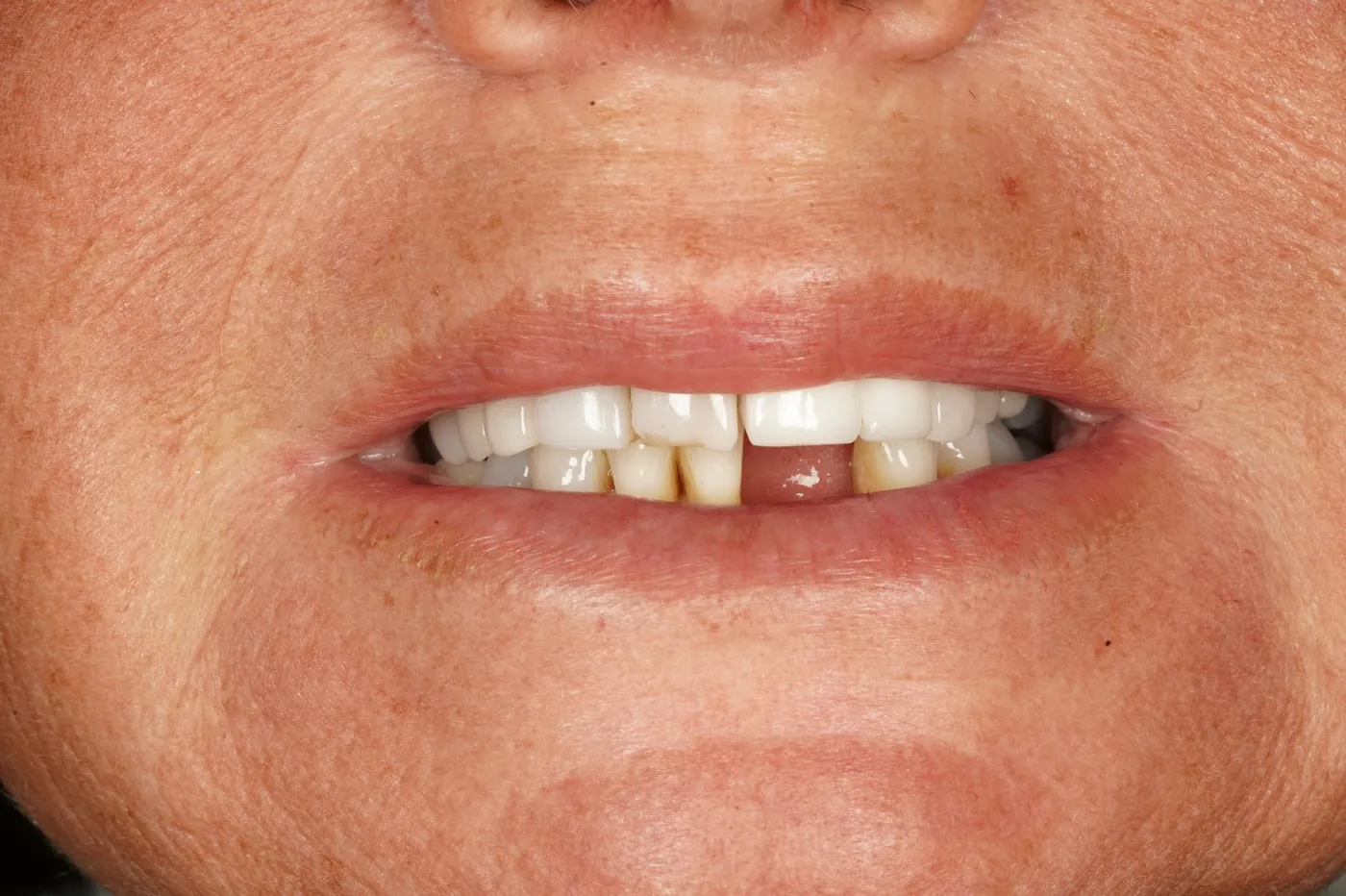 Before "nothing could be done" — small lower denture, big difference — Forest Dental Blackwood