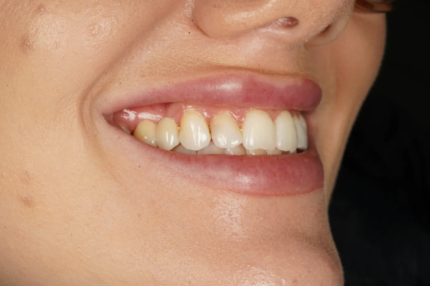 After closing a long-standing gap with a two-unit bridge — Forest Dental Blackwood