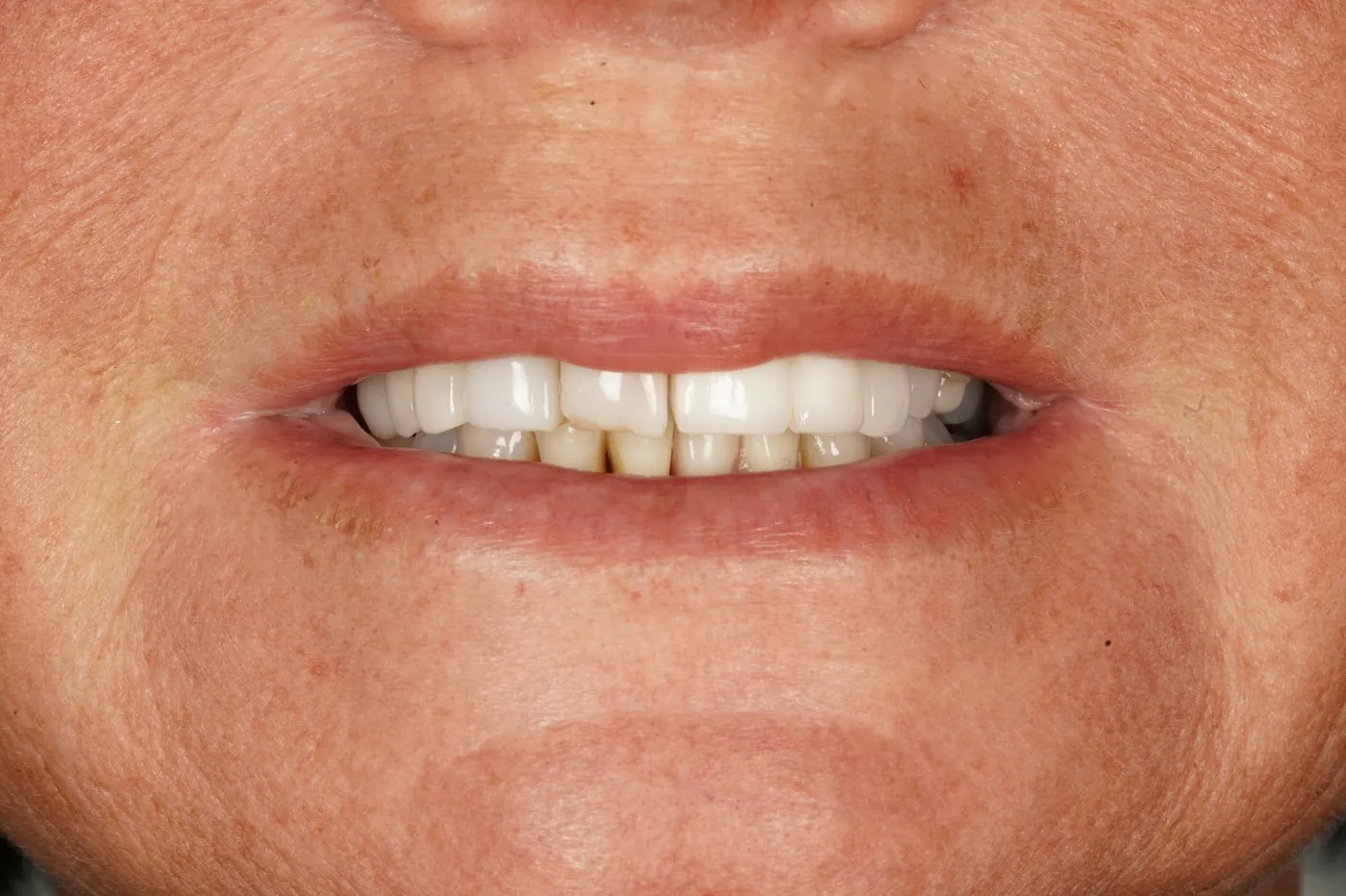 After "nothing could be done" — small lower denture, big difference — Forest Dental Blackwood