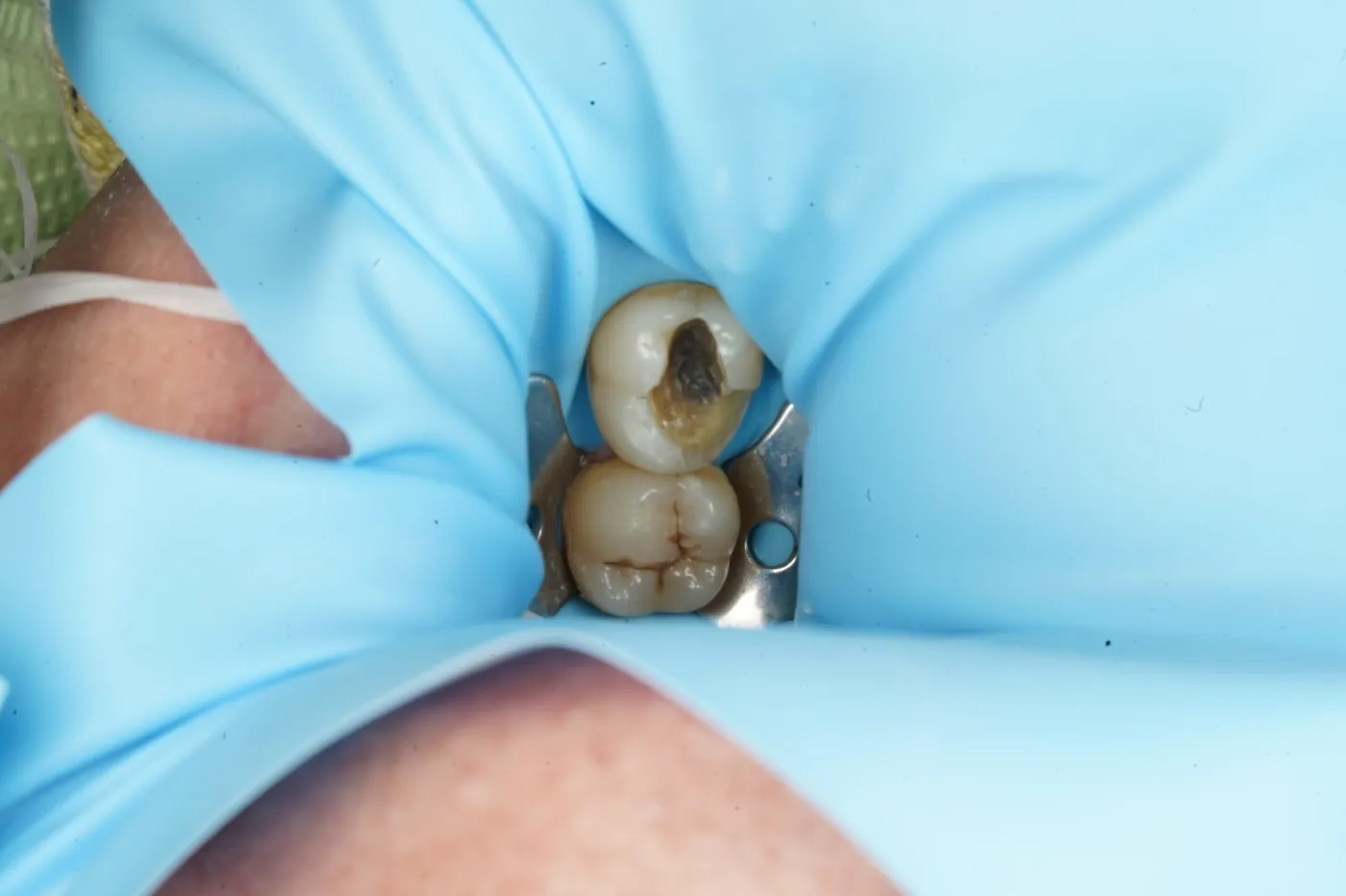Before saving a tooth others said couldn't be saved — emax onlay — Forest Dental Blackwood