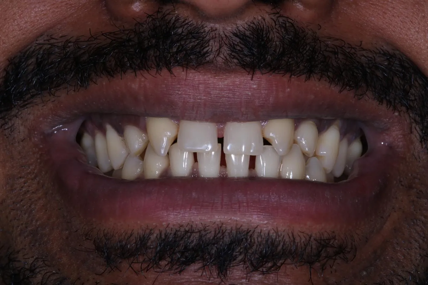 Before invisalign, whitening & bonding — reshaped retained baby teeth — Forest Dental Blackwood