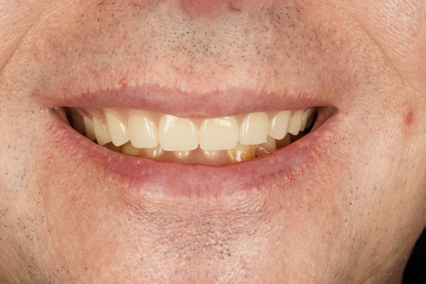 After full mouth clearance & immediate dentures — Forest Dental Blackwood