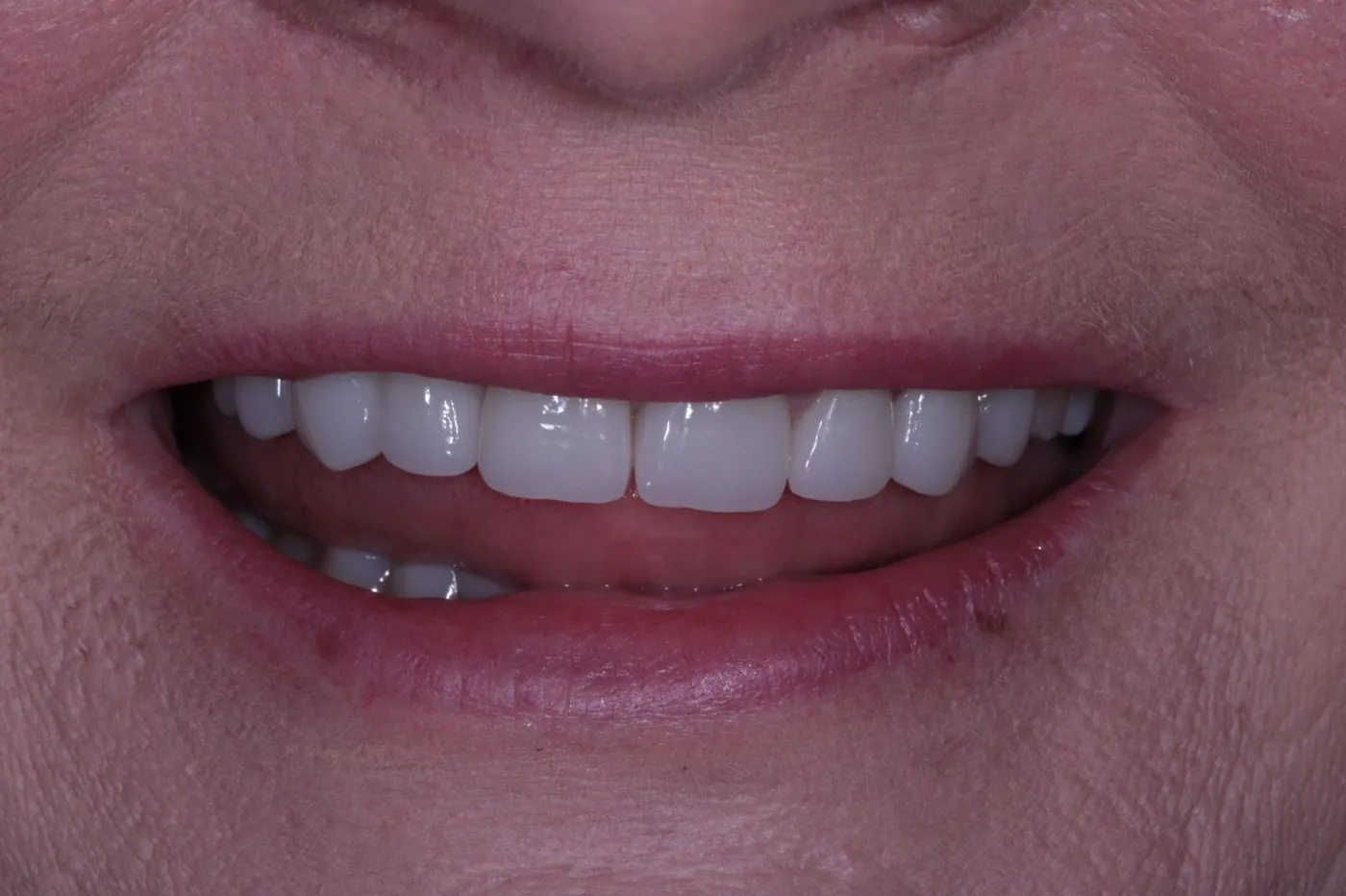 After severe wear restored — 8 zirconia crowns — Forest Dental Blackwood