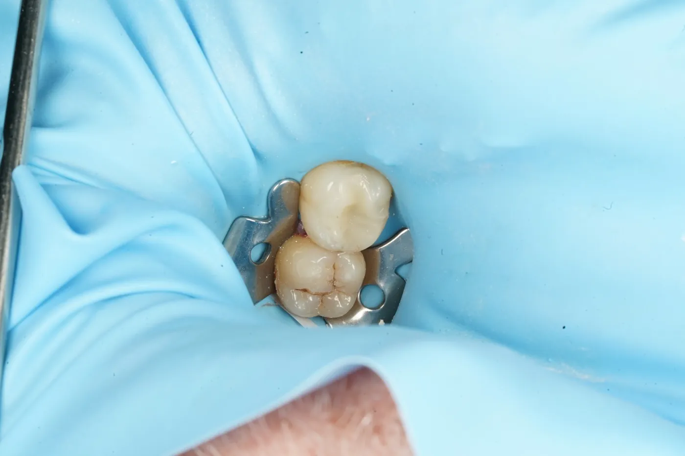 After saving a tooth others said couldn't be saved — emax onlay — Forest Dental Blackwood