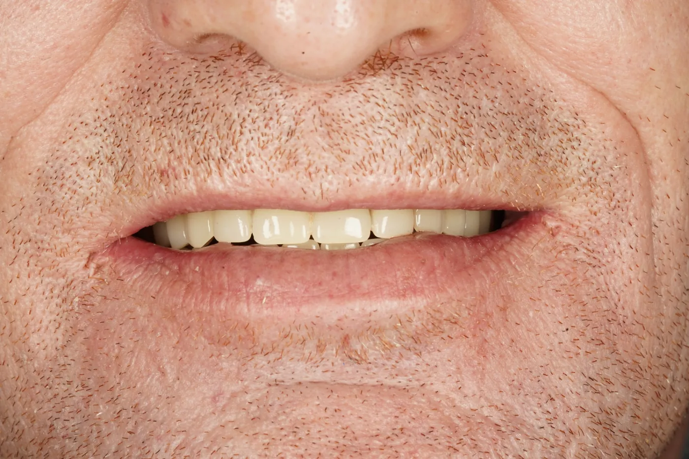 Smile Makeovers result at Forest Dental Blackwood