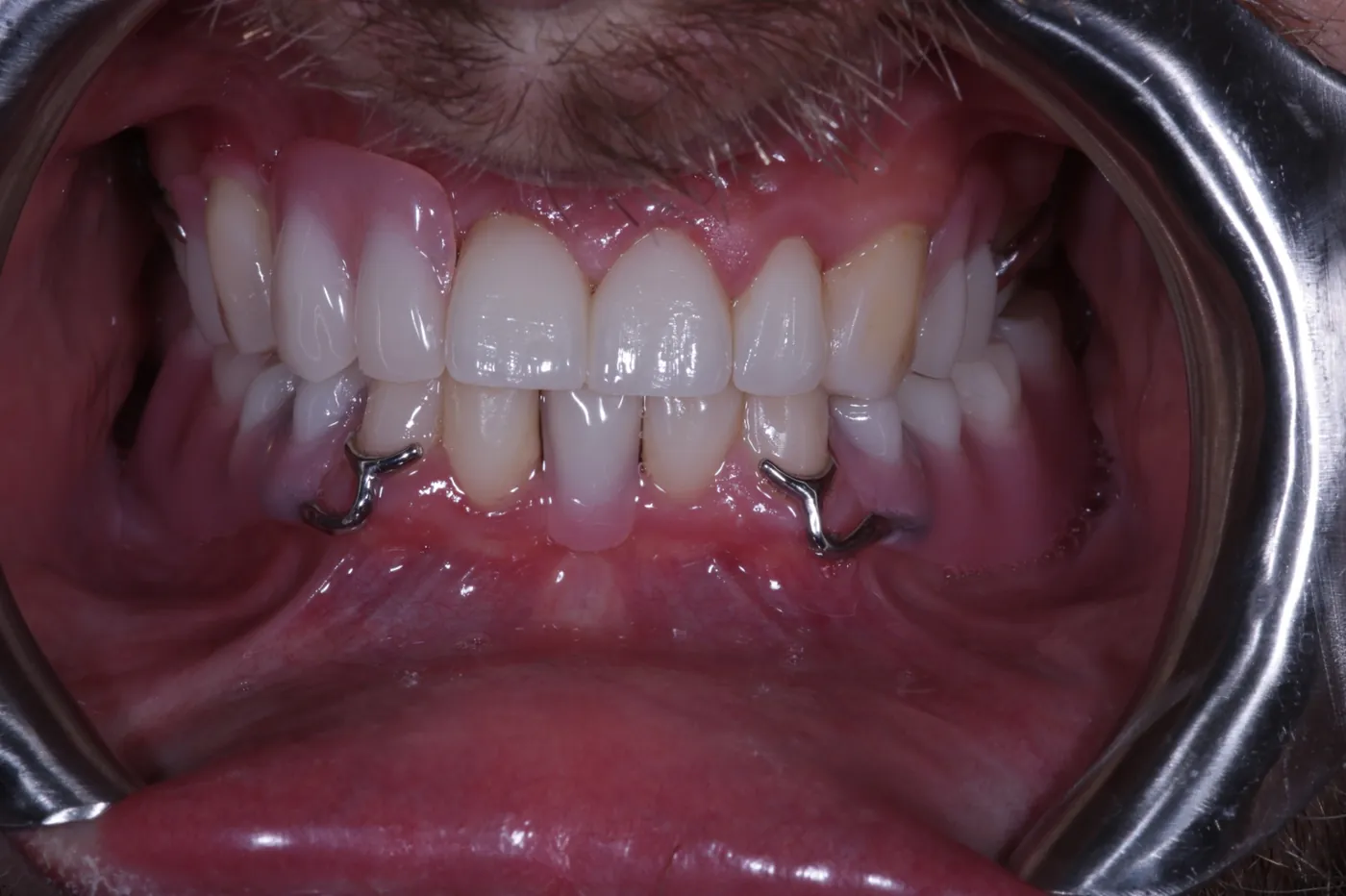 Composite Bonding result at Forest Dental Blackwood