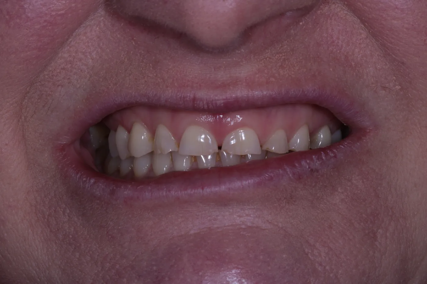 Before severe wear restored — 8 zirconia crowns — Forest Dental Blackwood
