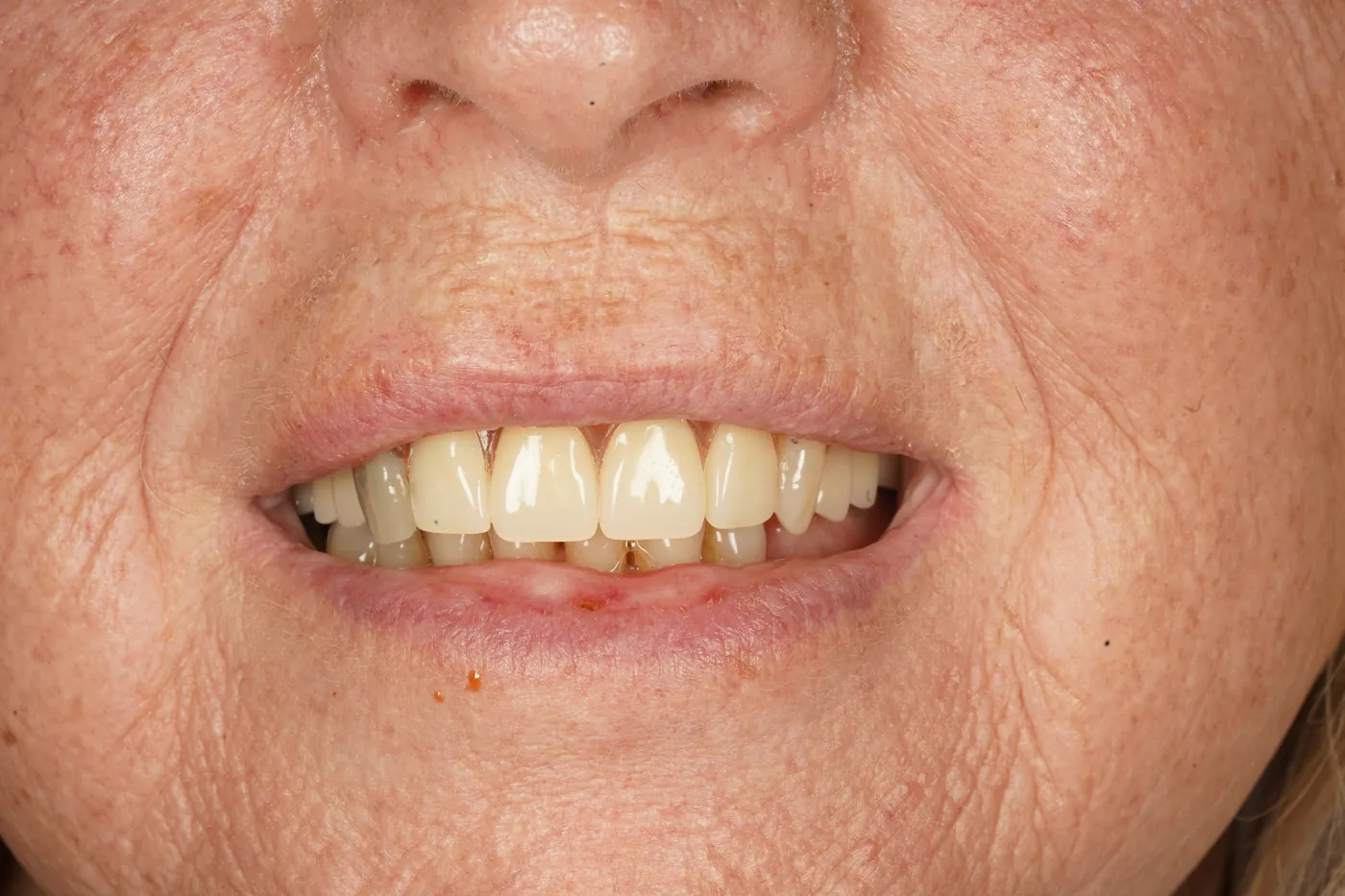 After patient-designed replacement denture — Forest Dental Blackwood