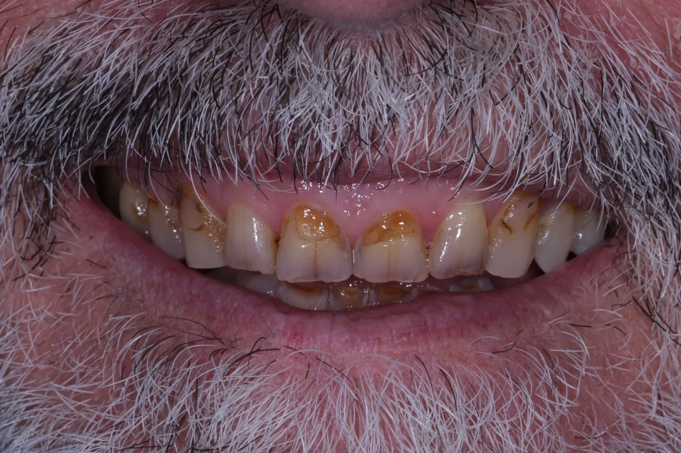 Before rebuilt & refreshed — composite bonding on 6 front teeth — Forest Dental Blackwood