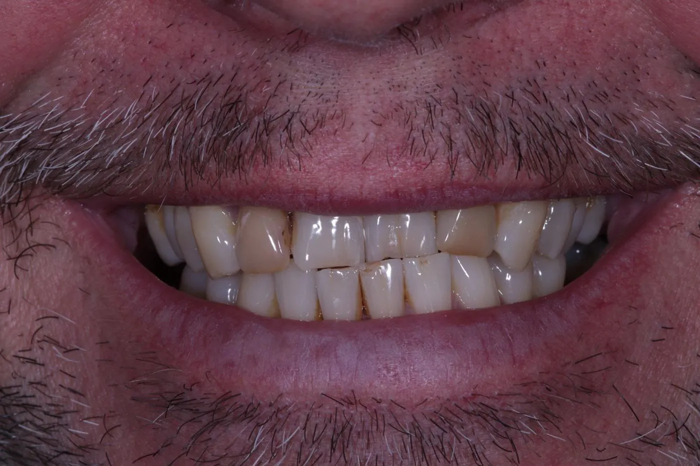 Before straightened, brightened & refined — invisalign with 4 emax veneers — Forest Dental Blackwood