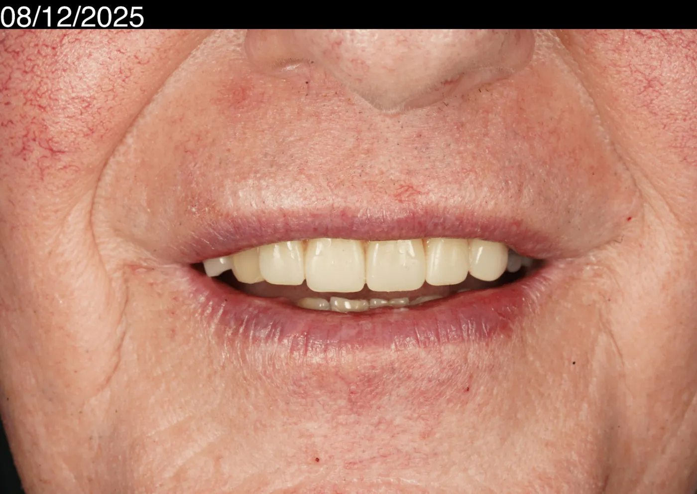 After a more secure smile — cobalt chrome denture — Forest Dental Blackwood