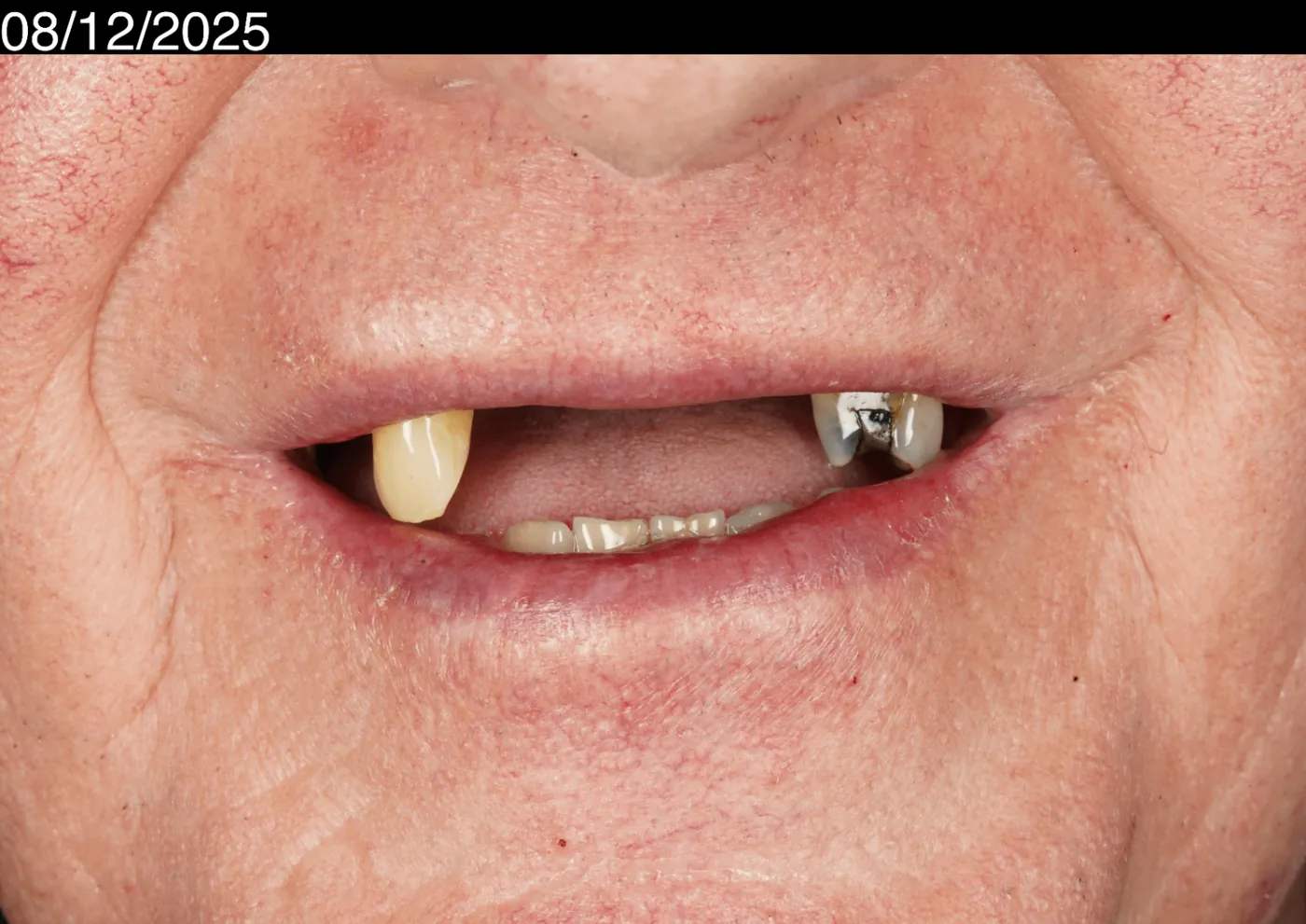 Before a more secure smile — cobalt chrome denture — Forest Dental Blackwood