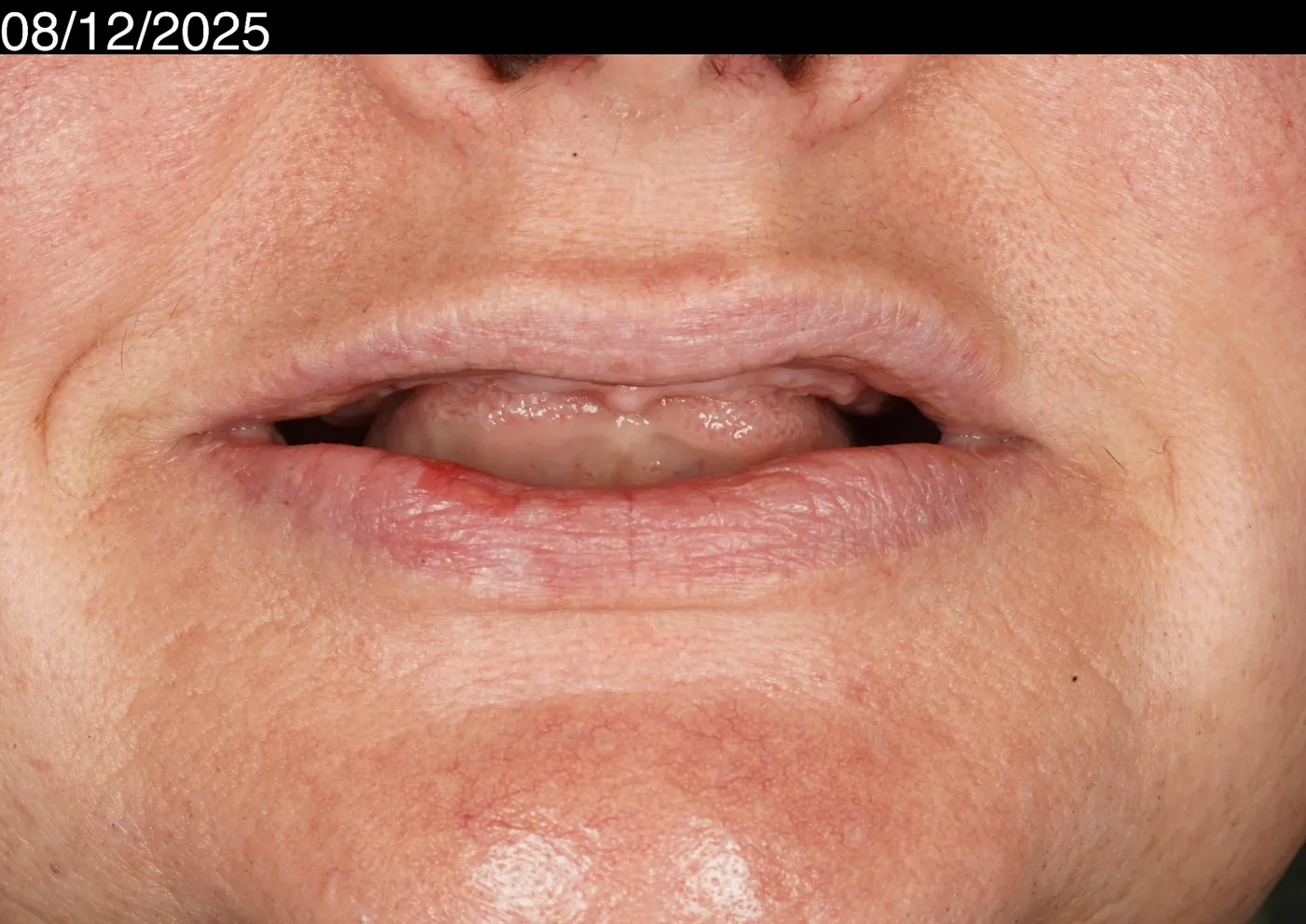 Before a first smile in years — upper acrylic denture — Forest Dental Blackwood