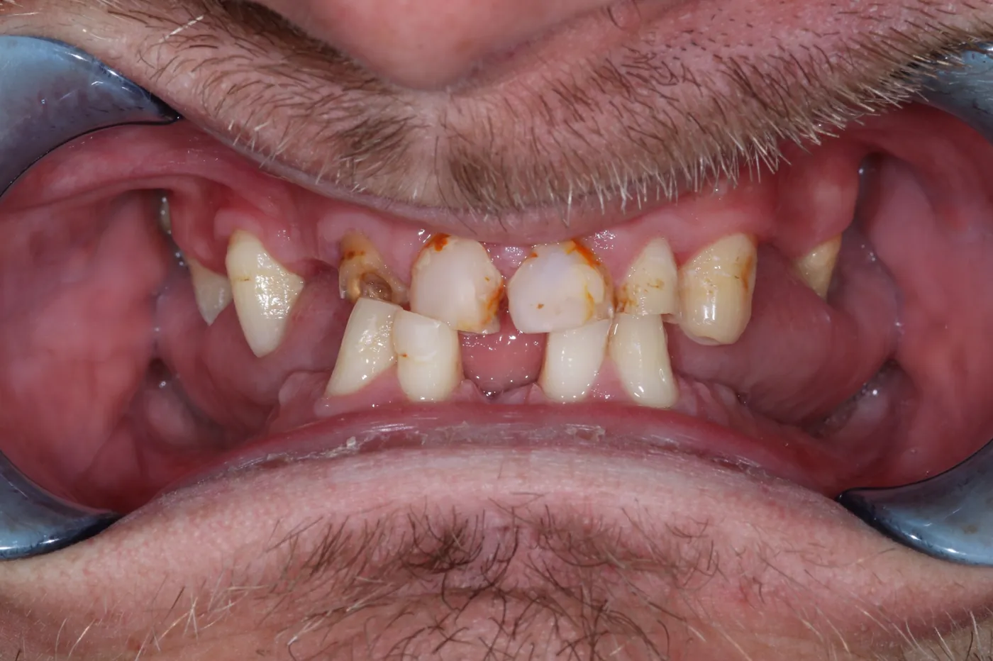 Before full smile rehabilitation — crowns, bonding & cobalt chrome dentures — Forest Dental Blackwood