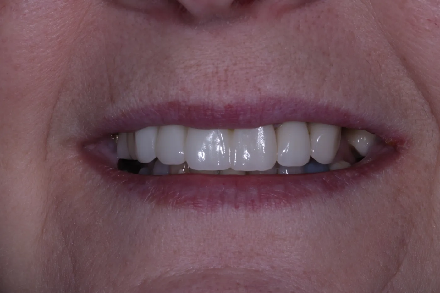 After digital smile design — 6 layered zirconia crowns — Forest Dental Blackwood