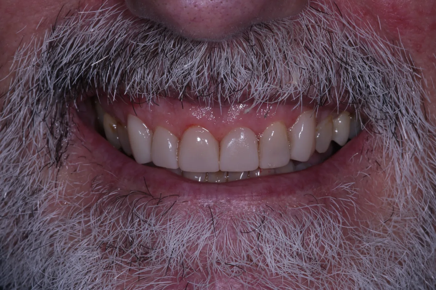 After rebuilt & refreshed — composite bonding on 6 front teeth — Forest Dental Blackwood