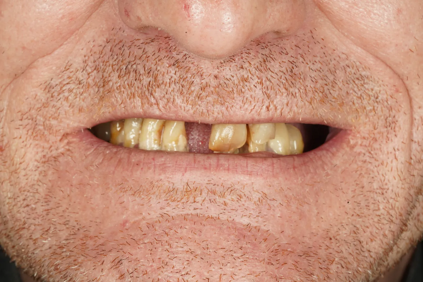 Before full mouth reset — upper & lower dentures after clearance — Forest Dental Blackwood