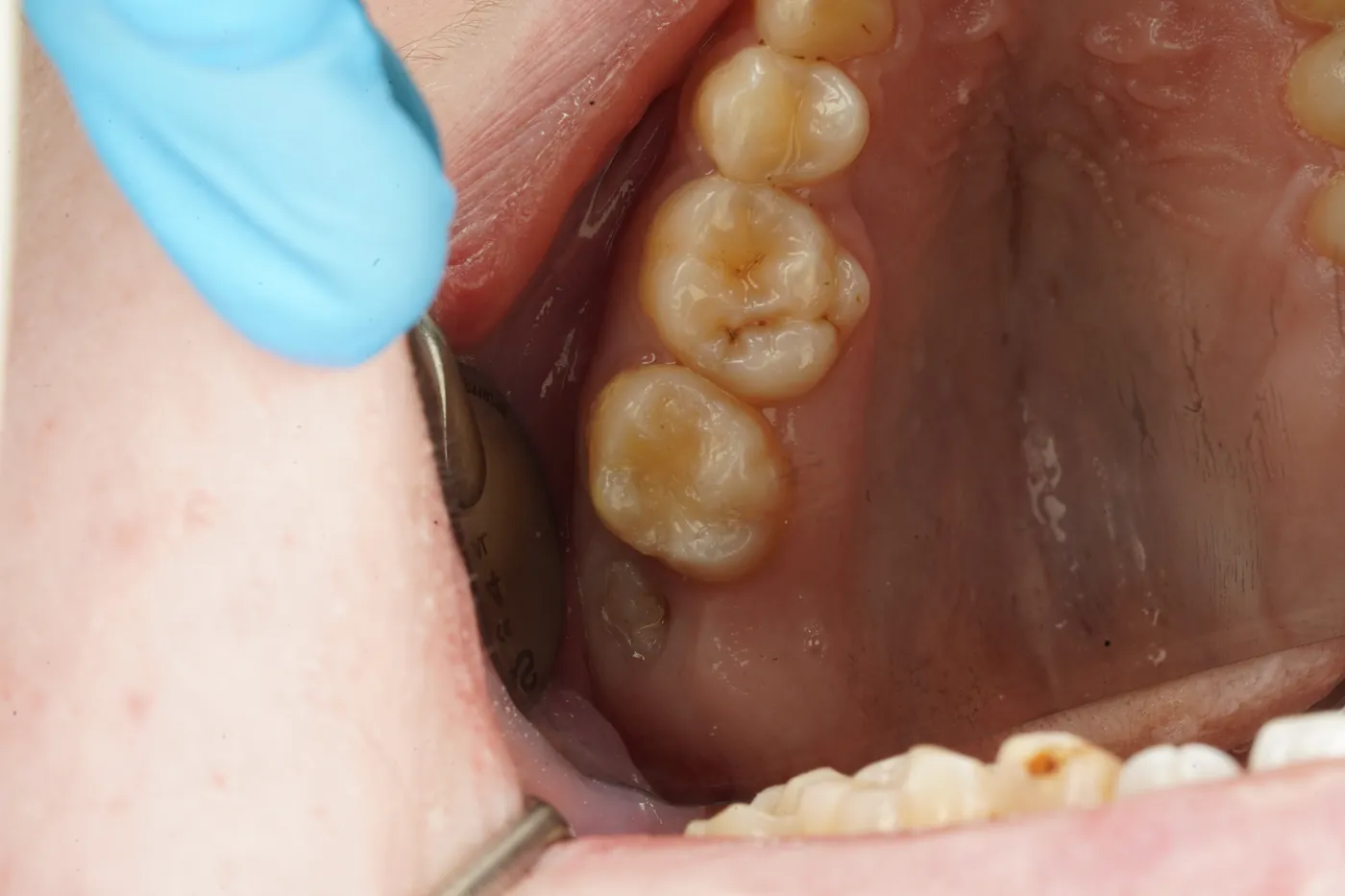 After sensitive to bite — small cavity, composite restoration — Forest Dental Blackwood